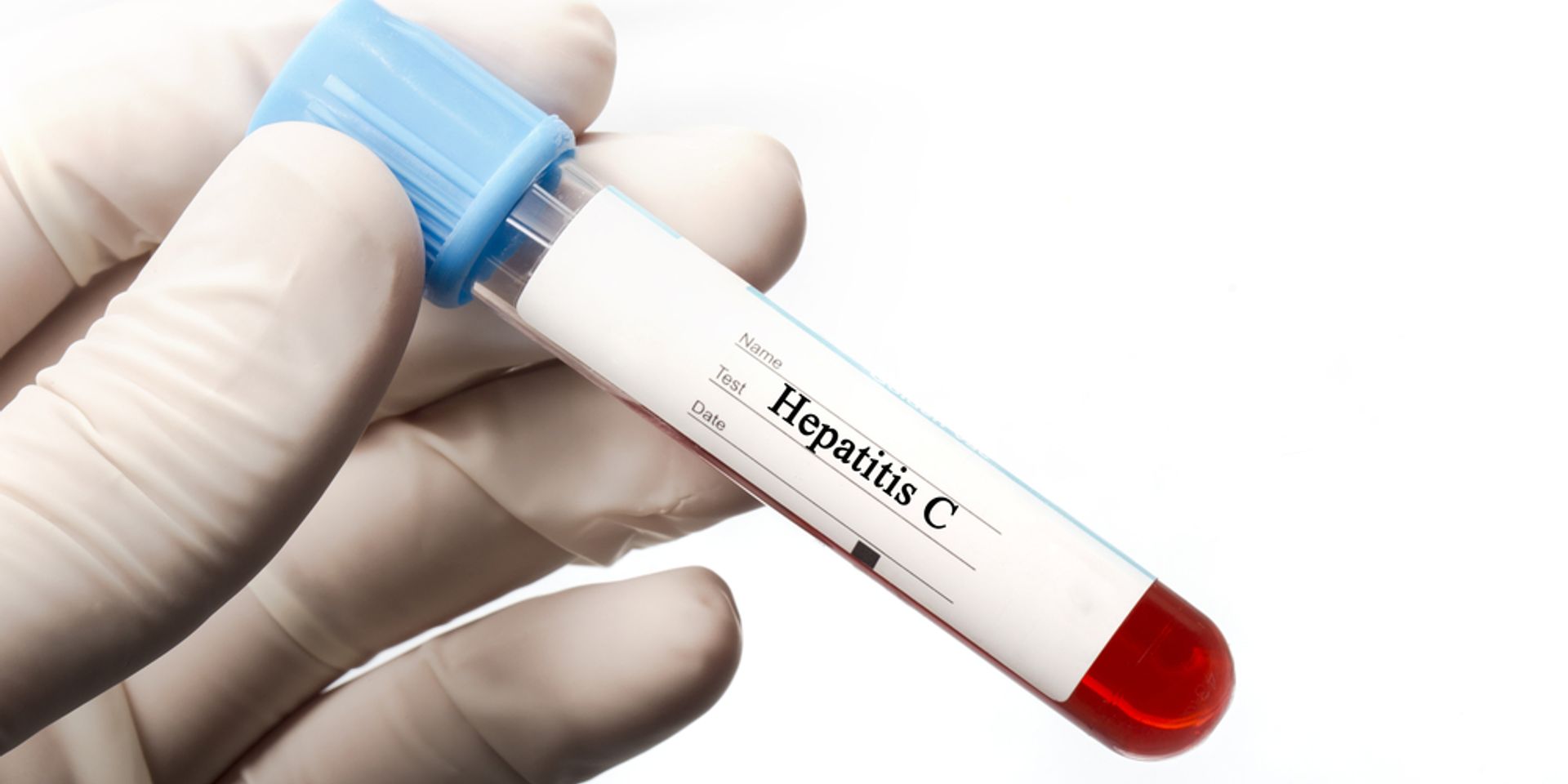 Ingyenes hepatitis C-szűrés lesz az ország több városában